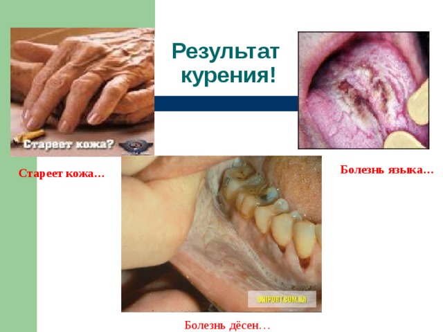 Результат  курения! Болезнь языка… Стареет кожа… Болезнь дёсен… 
