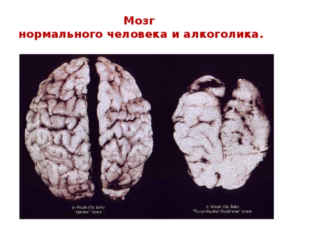 Мозг  нормального человека и алкоголика. 