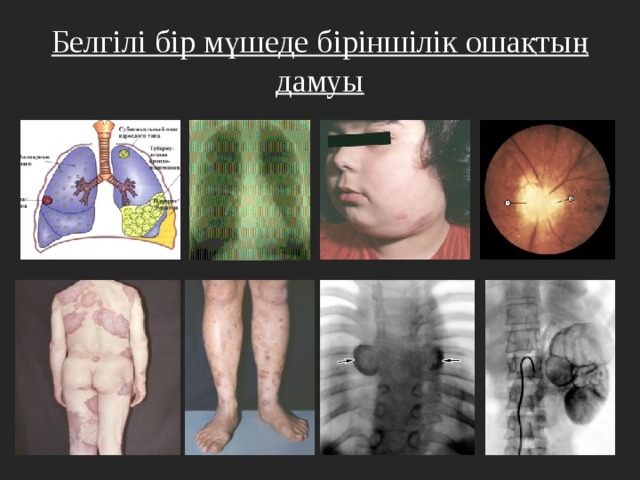 Белгілі бір мүшеде біріншілік ошақтың дамуы 