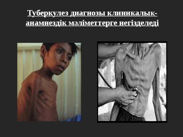 Туберкулез диагнозы клиникалық-анамнездік мәліметтерге негізделеді 