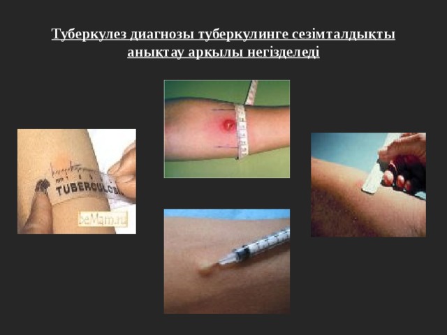 Туберкулез диагнозы туберкулинге сезімталдықты анықтау арқылы негізделеді 