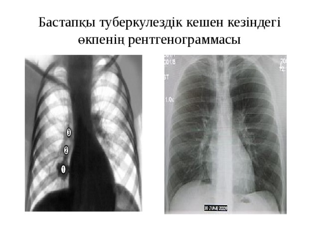 Бастапқы туберкулездік кешен кезіндегі өкпенің рентгенограммасы 