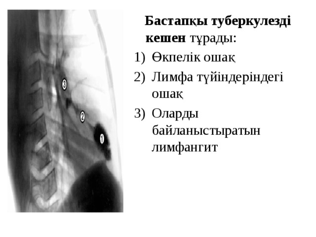  Бастапқы туберкулезді кешен тұрады: Өкпелік ошақ Лимфа түйіндеріндегі ошақ Оларды байланыстыратын лимфангит 