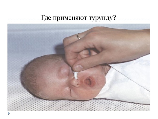 Где применяют турунду? 