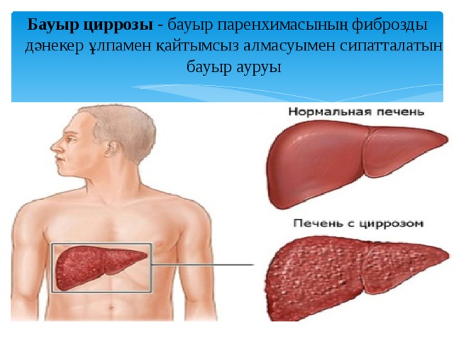 Способность печени к регенерации и проблема цирроза презентация