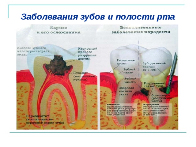 Заболевания зубов фото