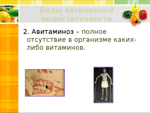Виды витаминной недостаточности  2.  Авитаминоз – полное отсутствие в организме каких-либо витаминов. 