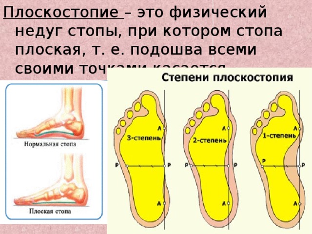 Степени плоскостопия таблица с картинками