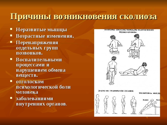 Причины возникновения сколиоза Неразвитые мышцы Возрастные изменения. Перенапряжения отдельных групп позвонков.  Воспалительными процессами и нарушением обмена веществ.  отголоском психологической боли человека заболеваниями внутренних органов . 