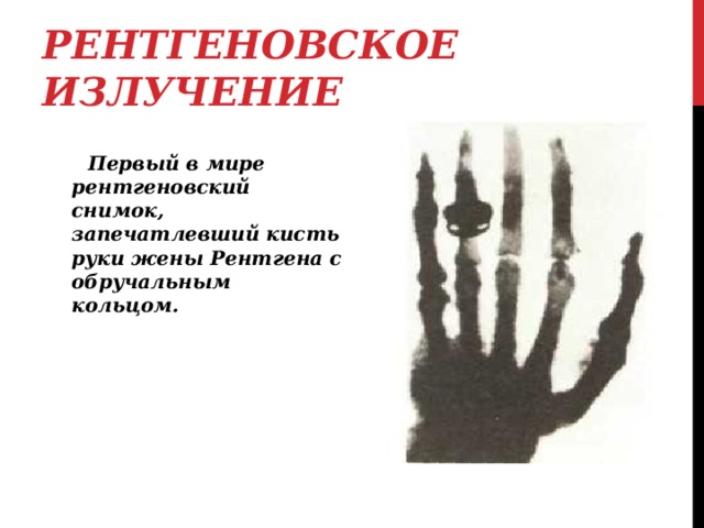 РЕНТГЕНОВСКОЕ ИЗЛУЧЕНИЕ  Первый в мире рентгеновский снимок, запечатлевший кисть руки жены Рентгена с обручальным кольцом. 