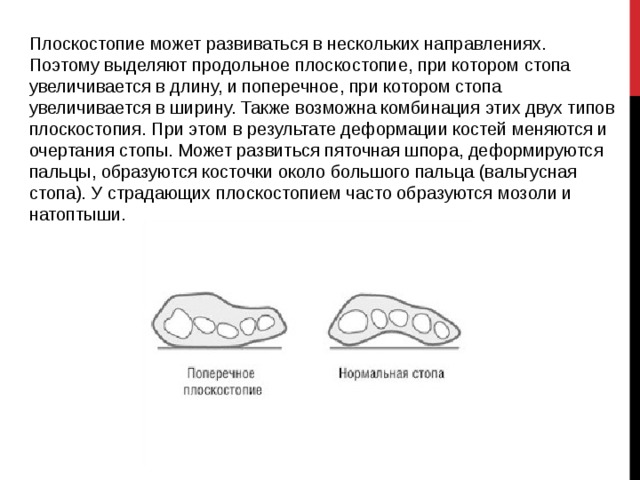 Плоскостопие может развиваться в нескольких направлениях. Поэтому выделяют продольное плоскостопие, при котором стопа увеличивается в длину, и поперечное, при котором стопа увеличивается в ширину. Также возможна комбинация этих двух типов плоскостопия. При этом в результате деформации костей меняются и очертания стопы. Может развиться пяточная шпора, деформируются пальцы, образуются косточки около большого пальца (вальгусная стопа). У страдающих плоскостопием часто образуются мозоли и натоптыши. 