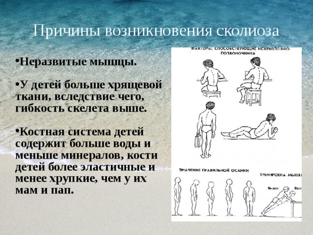 Профилактика сколиоза презентация