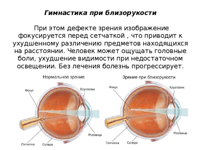 При близорукости изображение