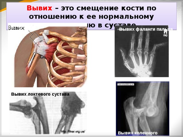 Смещение это. Вывихи костей классификация. Классификация вывиха фаланги. При закрытом переломе со смещением костей необходимо:. Классификация переломов и вывихов.