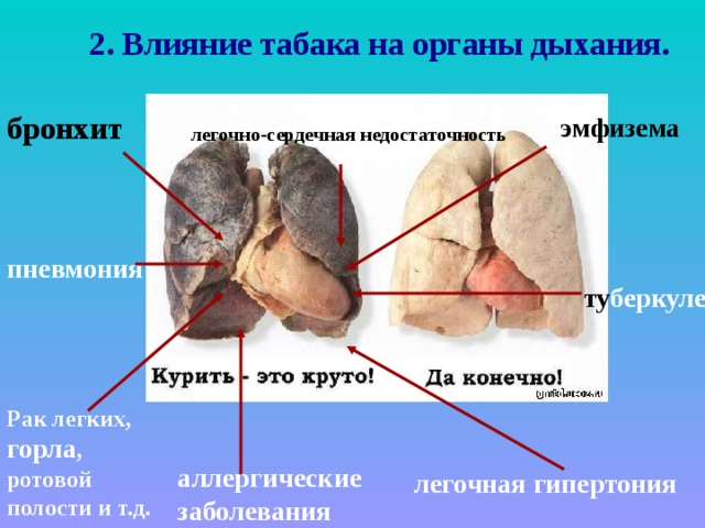 2. Влияние табака на органы дыхания. бронхит эмфизема легочно-сердечная недостаточность пневмония ту беркулез Рак легких, горла , ротовой полости и т.д. аллергические заболевания легочная гипертония  