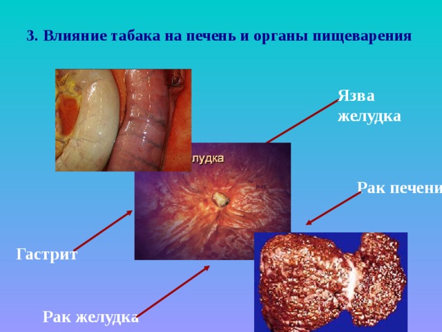 3. Влияние табака на печень и органы пищеварения Язва желудка Рак печени Гастрит  Рак желудка  