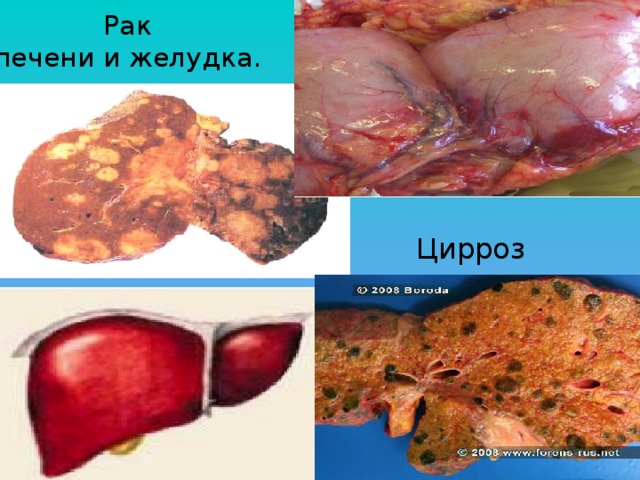 Рак  печени и желудка. Цирроз печени 