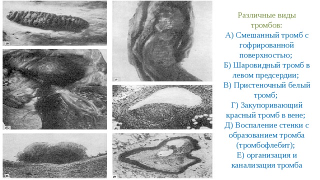 Тромб в сосуде на экране уз сканера выглядят как