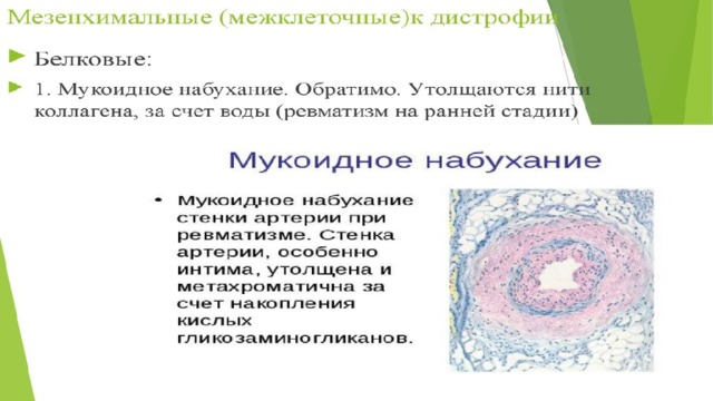 Мукоидное набухание макроскопическая картина