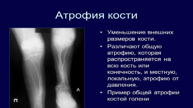 Атрофия презентация патология