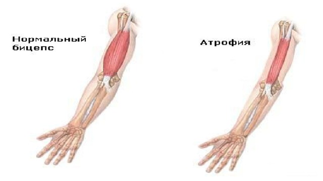 Мышечная атрофия