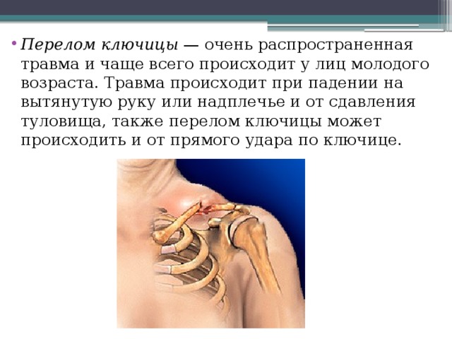 Перелом ключицы — очень распространенная травма и чаще всего происходит у лиц молодого возраста. Травма происходит при падении на вытянутую руку или надплечье и от сдавления туловища, также перелом ключицы может происходить и от прямого удара по ключице. 