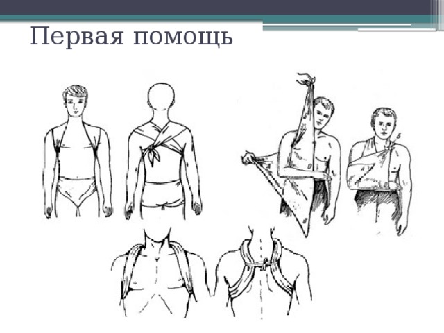 Перелом ключицы первая помощь. Иммобилизация при переломе ключицы. Иммобилизация руки при переломе ключицы. Перевязка при переломе ключицы. Вывих плечевого сустава иммобилизация.