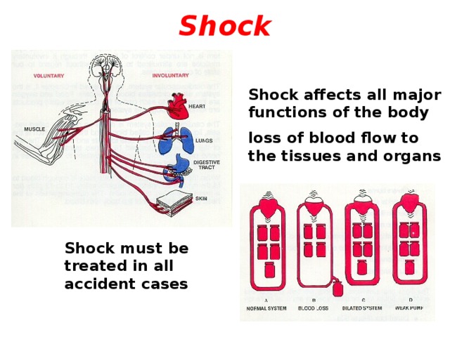 Shock Shock affects all major functions of the body loss of blood flow to the tissues and organs Shock must be treated in all accident cases  