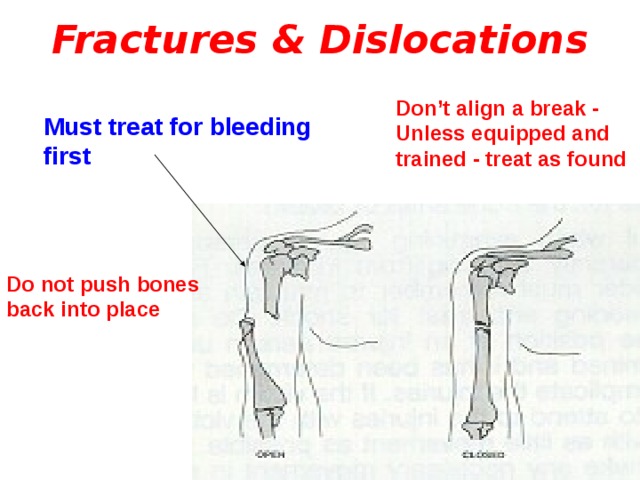 Fractures & Dislocations Don’t align a break - Unless equipped and trained - treat as found Must treat for bleeding first Do not push bones back into place 