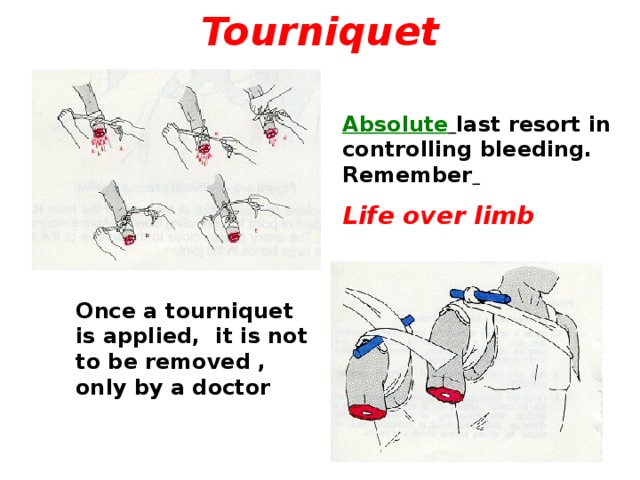Tourniquet Absolute  last resort in controlling bleeding. Remember  Life over limb Once a tourniquet is applied, it is not to be removed , only by a doctor  
