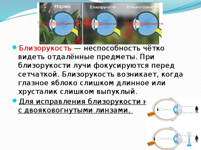 Если изображение фокусируется перед сетчаткой глаза то возникает