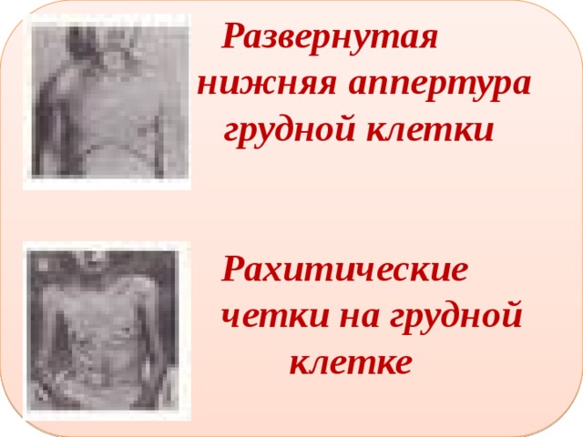   Развернутая  нижняя аппертура  грудной клетки    Рахитические  четки на грудной  клетке     