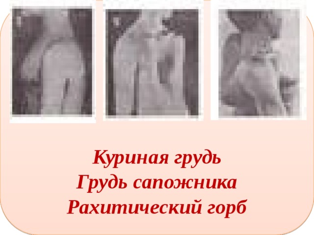 Куриная грудь Грудь сапожника   Рахитический горб  