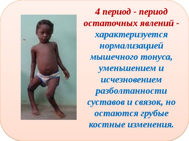  4 период - период остаточных явлений - характеризуется нормализацией мышечного тонуса, уменьшением и исчезновением разболтанности суставов и связок, но остаются грубые костные изменения. 