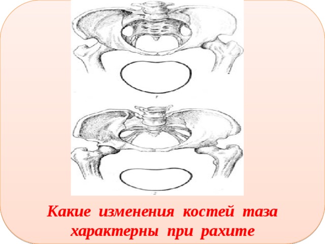 Изменения костей таза. Изменение таза при рахите. Плоский таз при рахите. Расширение тазовых костей у мужчин при рахите.