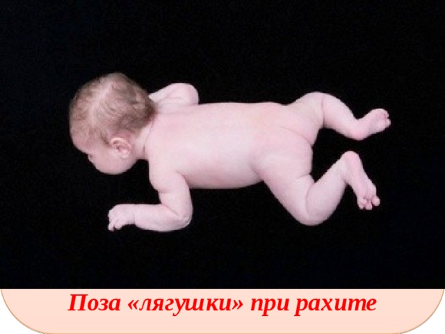           Поза «лягушки» при рахите 