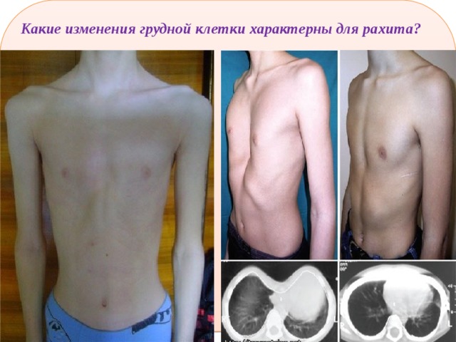 Какие изменения грудной клетки характерны для рахита? 