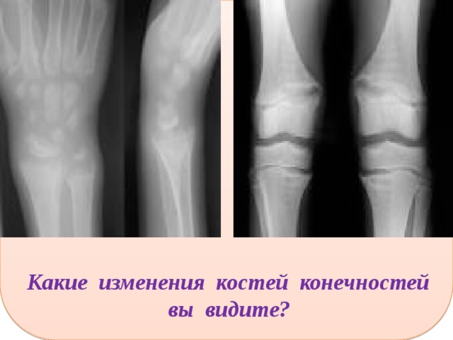  Какие изменения костей конечностей вы видите? 
