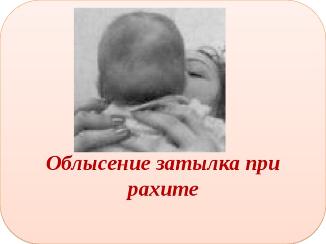   Облысение затылка при рахите 