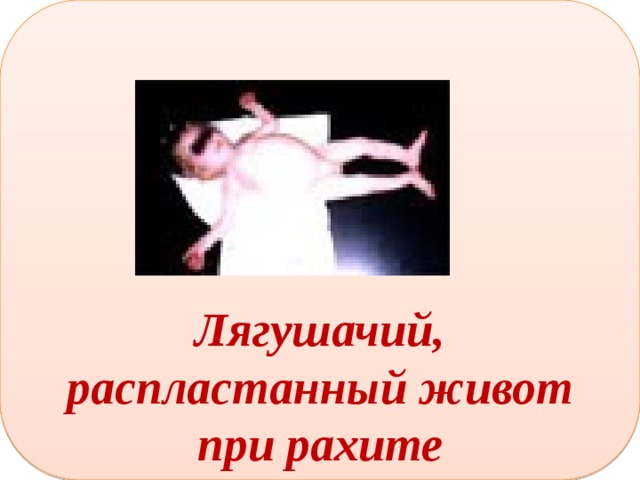      Лягушачий, распластанный живот при рахите 