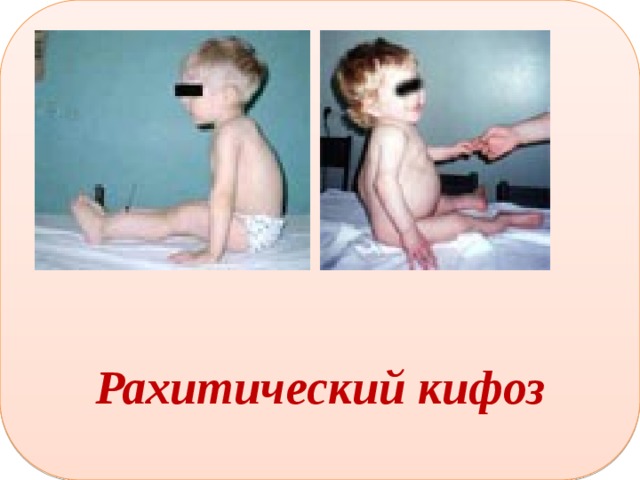      Рахитический кифоз 