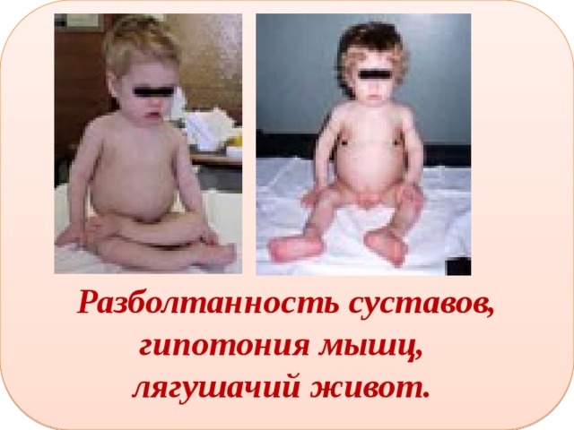       Разболтанность суставов, гипотония мышц, лягушачий живот.  