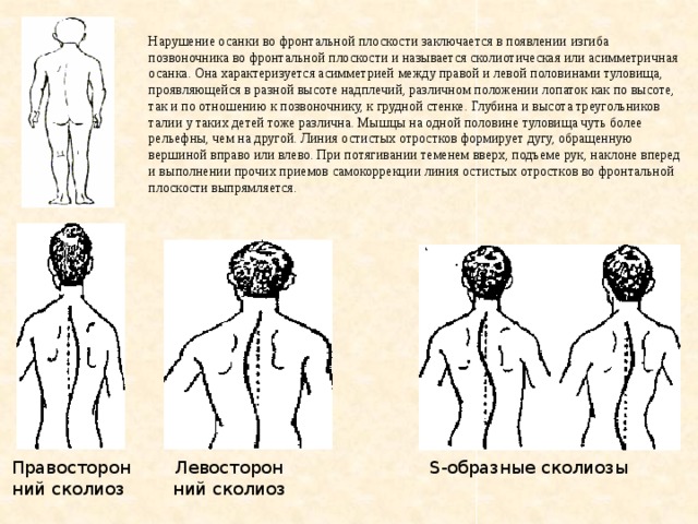 Фронтальная плоскость позвоночника. Виды нарушения осанки во фронтальной плоскости. Сколиотическая осанка характеризуется. Дефекты осанки во фронтальной плоскости. Асимметричная или сколиотическая осанка.