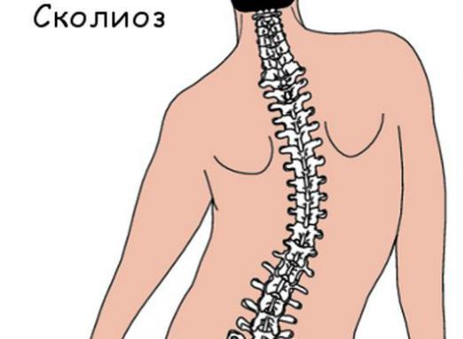 Два позвоночника у человека. Ишиалгический сколиоз. Сколиоз позвоночника схема. Искривление позвоночника рисунок. Сколиоз иллюстрация.