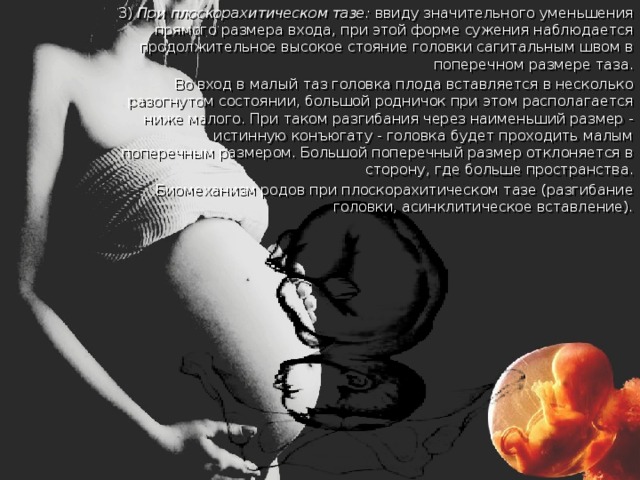  3) При плоскорахитическом тазе: ввиду значительного уменьшения прямого размера входа, при этой форме сужения наблюдается продолжительное высокое стояние головки сагитальным швом в поперечном размере таза.  Во вход в малый таз головка плода вставляется в несколько разогнутом состоянии, большой родничок при этом располагается ниже малого. При таком разгибания через наименьший размер - истинную конъюгату - головка будет проходить малым поперечным размером. Большой поперечный размер отклоняется в сторону, где больше пространства.  Биомеханизм родов при плоскорахитическом тазе (разгибание головки, асинклитическое вставление). 