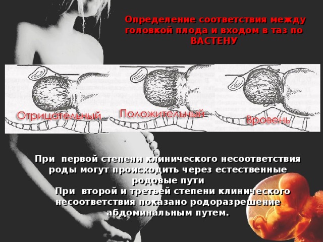  Определение соответствия между головкой плода и входом в таз по ВАСТЕНУ При первой степени клинического несоответствия роды могут происходить через естественные родовые пути  При второй и третьей степени клинического несоответствия показано родоразрешение абдоминальным путем. 