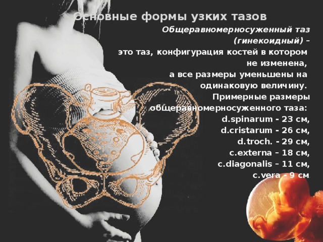  Основные формы узких тазов  Общеравномерносуженный таз (гинекоидный) –  это таз, конфигурация костей в котором не изменена, а все размеры уменьшены на одинаковую величину.  Примерные размеры  общеравномерносуженного таза:  d.spinarum - 23 см,  d.cristarum - 26 см,  d.troch. - 29 см,  с.externa – 18 см,  с.diagonalis – 11 cм,  c.vera - 9 см . 