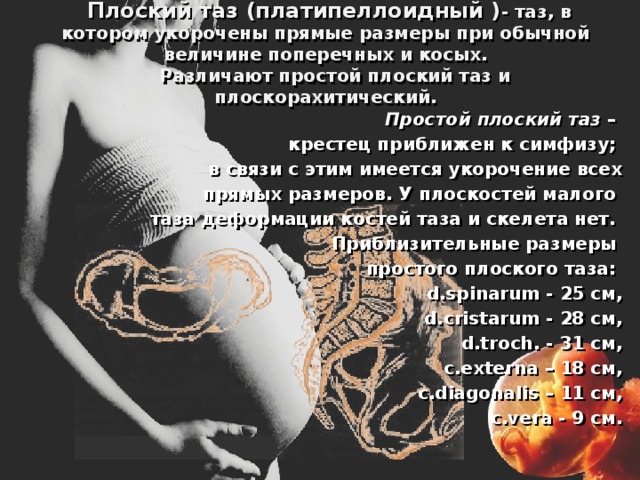  Плоский таз (платипеллоидный ) - таз, в котором укорочены прямые размеры при обычной величине поперечных и косых.  Различают простой плоский таз и плоскорахитический. Простой плоский таз – крестец приближен к симфизу; в связи с этим имеется укорочение всех  прямых размеров. У плоскостей малого таза деформации костей таза и скелета нет. Приблизительные размеры простого плоского таза:  d.spinarum - 25 см,  d.cristarum - 28 см,  d.troch . - 31 см,  с.externa – 18 см,  с.diagonalis – 11 cм,  c.vera - 9 см.  