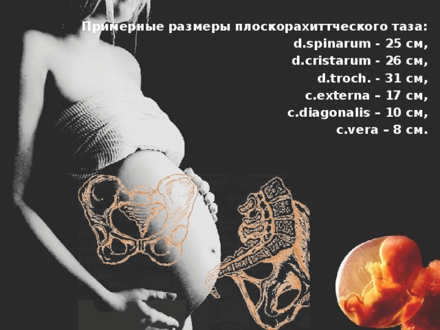 Примерные размеры плоскорахиттческого таза:  d.spinarum - 25 см,  d.cristarum - 26 см,  d.troch. - 31 см,  с.externa – 17 см,  с.diagonalis – 10 cм,  c.vera – 8 см. 