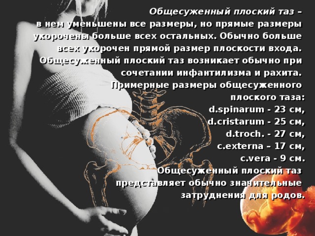 Общесуженный плоский таз – в нем уменьшены все размеры, но прямые размеры укорочены больше всех остальных. Обычно больше всех укорочен прямой размер плоскости входа. Общесуженный плоский таз возникает обычно при сочетании инфантилизма и рахита.  Примерные размеры общесуженного плоского таза:  d.spinarum - 23 см,  d.cristarum - 25 см,  d.troch. - 27 см,  с.externa – 17 см,  c.vera - 9 см.  Общесуженный плоский таз представляет обычно значительные затруднения для родов. 